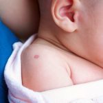 Jak wygląda ślad po szczepionce przeciw gruźlicy?