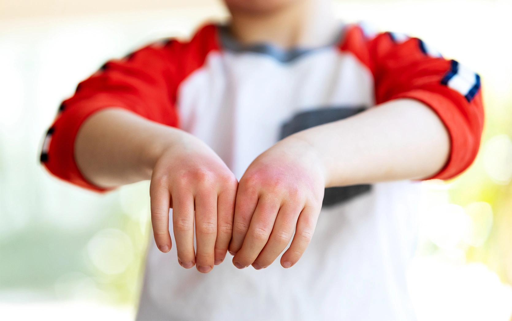 Alergia kontaktowa u dziecka - objawy, przyczyny, leczenie